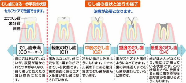 むし歯の進行